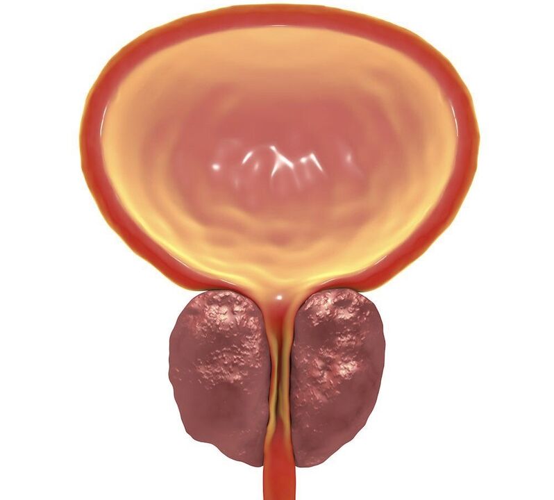 upala kroničnog prostatitisa