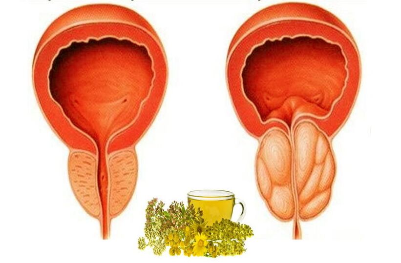 Zdrava i bolna prostata